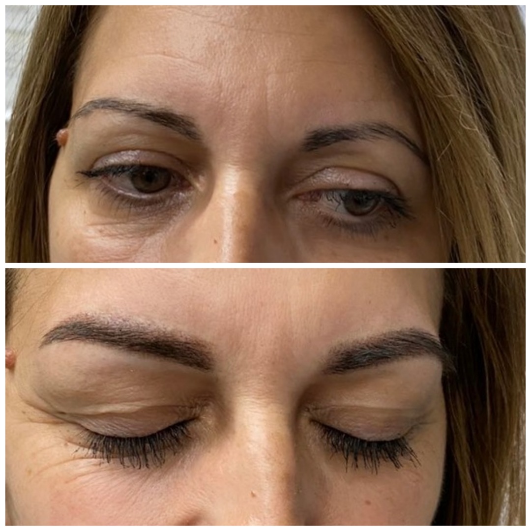 Sourcils restructurés avant après